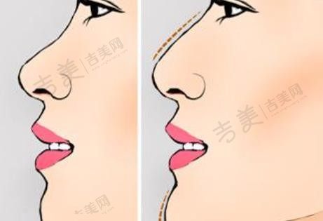 韩式隆鼻