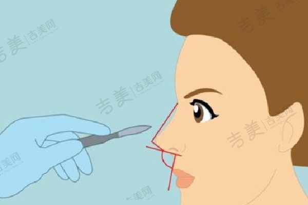 范荣杰做鼻修复价格范围在4W至6W元值吗：非常值得擅长肋软骨/耳软骨/假体鼻挛缩修复