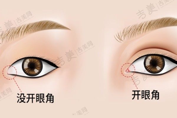 上海陈小剑医生外眼角修复1.8W:显微双眼皮亲测值得打造自然动人的眼睛美感