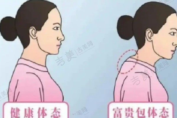 深圳曹孟君医疗美容门诊部富贵包抽脂收费2W元:曹医生采用土麦森去富贵包技术去除相当干净优势多多