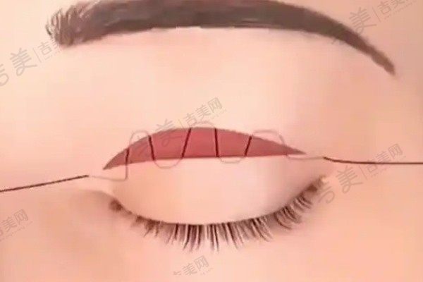 师丽丽双眼皮修复成功费用25800元！北京丰联丽格招牌医生极高眼修复技术助你重拾自信