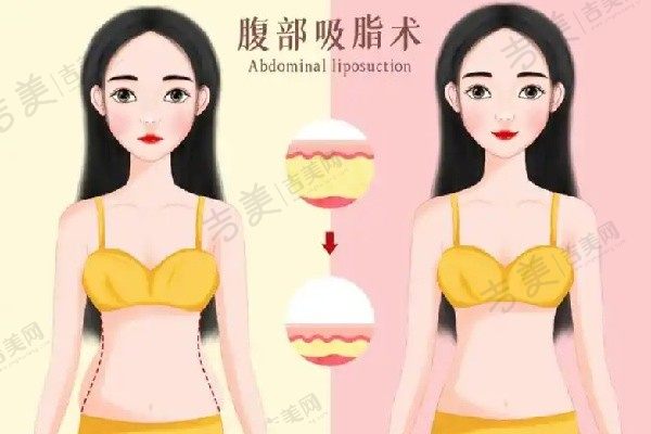 北京王明利医生面部脂肪填充项目报价2万左右，技术领跑、成效显著，刷新自信面庞