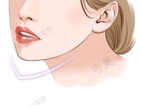v－line瓜子脸手术.jpg