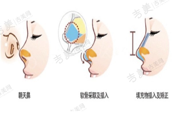 范荣杰鼻修复手术收费价格