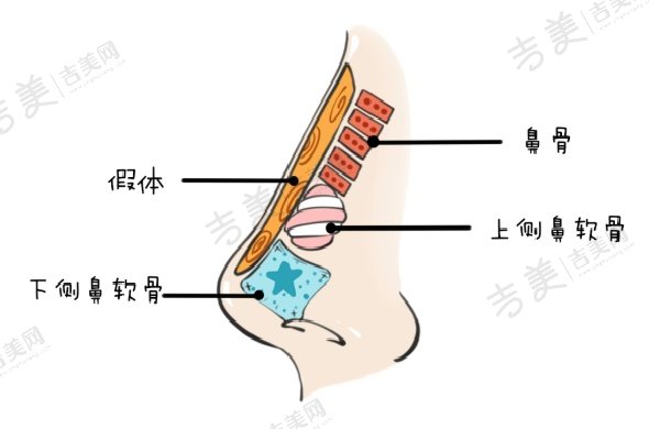 为什么范荣杰的鼻修复值得这价格？值得吗
