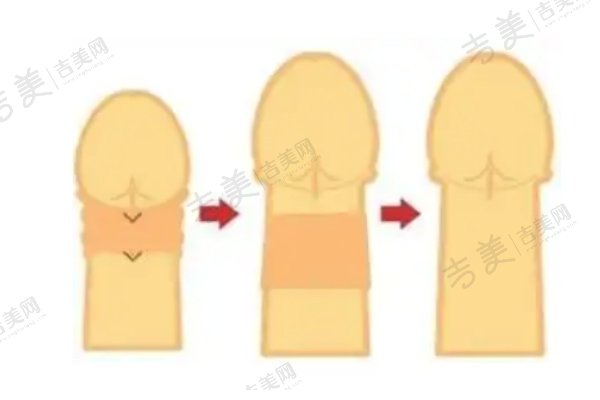adm生物补片增粗后会不会被吸收