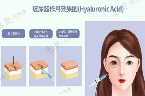 陈万芳自体脂肪填充面部术后体验与成效