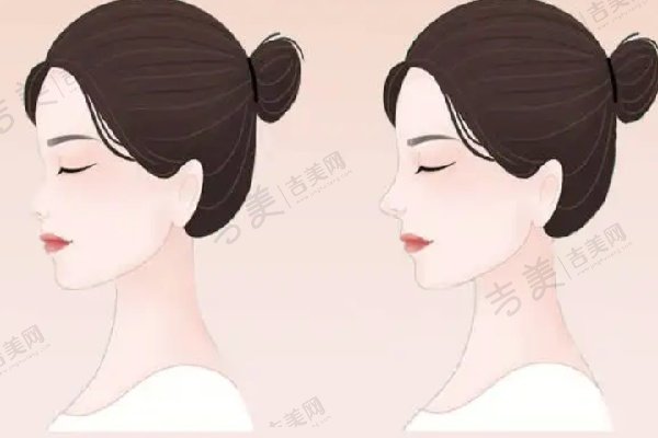 北医三院薛红宇注射鼻综合项目简介