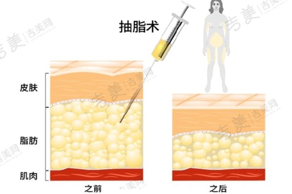 任学会吸脂吸脂项目10W真不贵