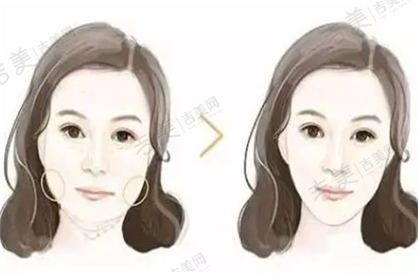 上海馥兰朵生长因子取出手术项目价格及操作流程
