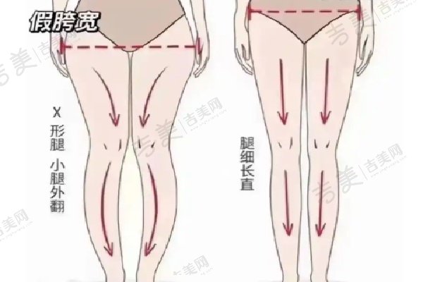 北京艺美王东脂肪修复术后修复