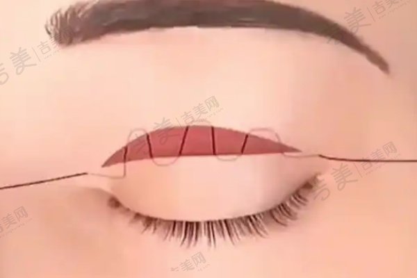 上海华美整形医院陈小剑外眼角修复真人实例