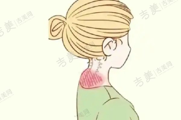 深圳曹孟君医院土麦森吸脂真人实例