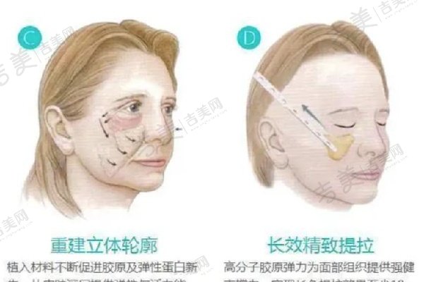 成都素美医院李建刚做无痕筋膜提升技术优势