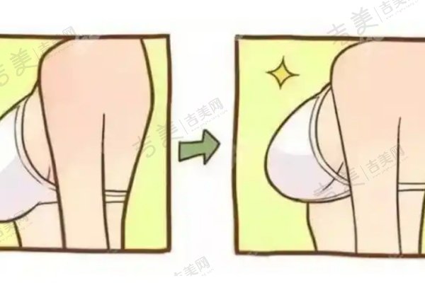 项力源丰胸全包价解析