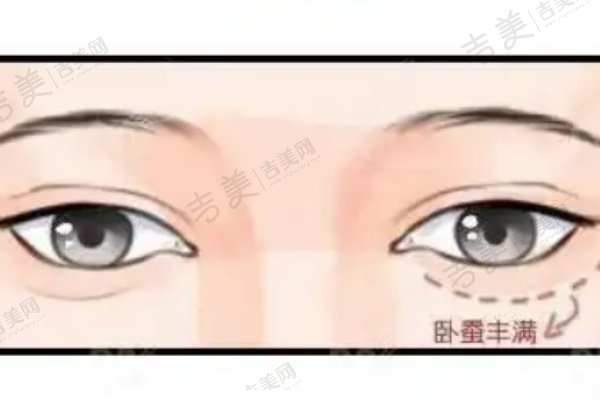 北京丰联丽格整形医院师丽丽双眼皮修复真实实例