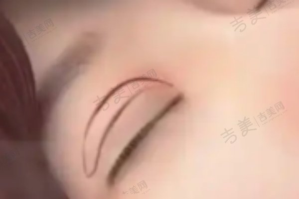  北京丰联丽格整形医院师丽丽双眼皮修复预约攻略