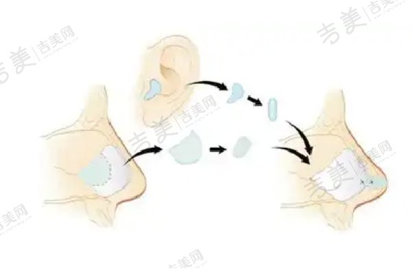 北京沃尔刘彦军鼻子修复项目价格及操作流程