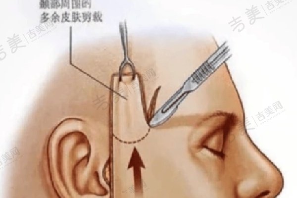 成都李建钢筋膜提升靠谱吗？面部抗衰成效明显获做筋膜提升者好评！