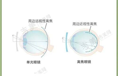沧州爱尔眼科医院就诊有哪些贴士?