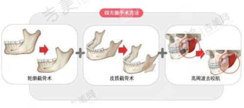 商丘华美医疗美容医院怎么样，口碑评价如何？