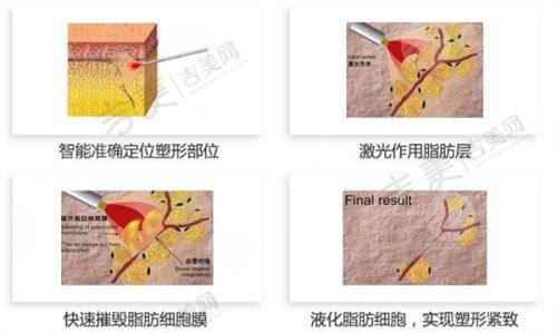湛江华美整形美容医院怎么样,口碑评价如何?