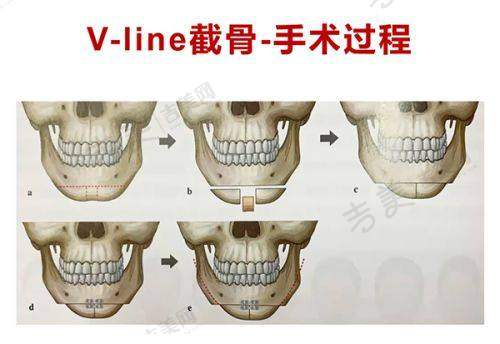 2025年张立天在成都东篱医院任职详情之磨骨技术怎么样？