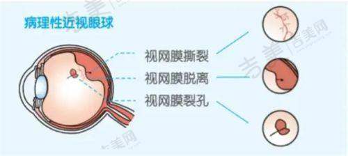 朋友们对贵阳市角膜塑形镜(OK镜)相关医院的真实评价分享详情——贵州晶朗眼科医院