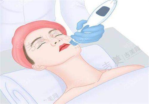 宁夏华美整形美容膨体隆鼻修复52000元起常见疑问专精解答