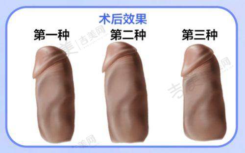 重庆星荣整颧骨降低16296元起，刘正茂定制面部立体度提升，手术创伤小修复快医生介绍