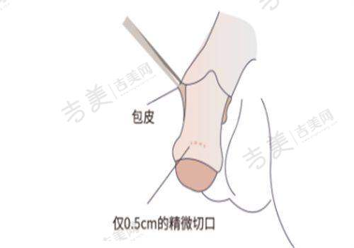 孝感华美医疗美容背部吸脂48000元起划算与否探讨