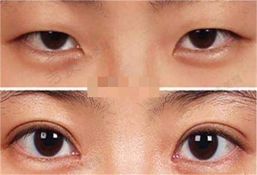 隆胸假体高凸中凸怎么选择之傲诺拉星熠假体分析