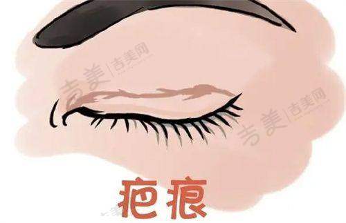 隆胸假体10年以上不取出，渗漏或破裂有啥临床表现