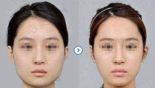 假体隆胸后遗症有哪些?包含感染、移位等风险,选正规医院可约降低丰胸