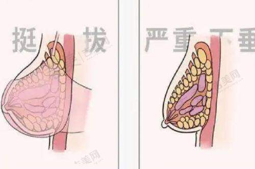 需要更换假体隆胸的情况