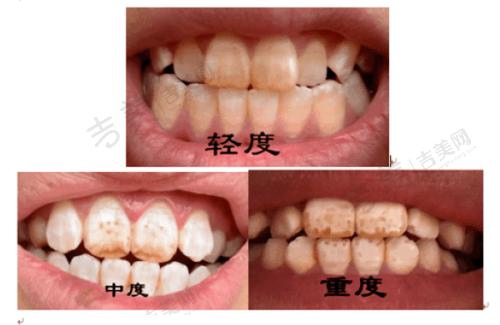 如何选择合适价格的可丽尔隐形矫正