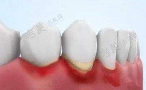 美国皓圣种植牙术后维护到底如何