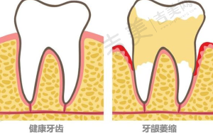 美国拉瓦全瓷牙一般多少钱一个——不同牙齿部位价格不同