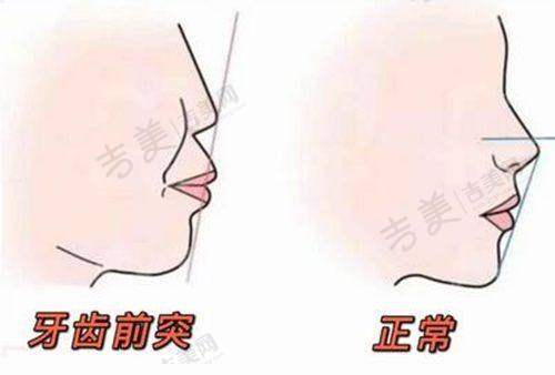 不同类型精密附着体义齿的时长区别