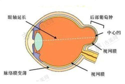四、西安四院眼科近视手术手术费情况深度剖析