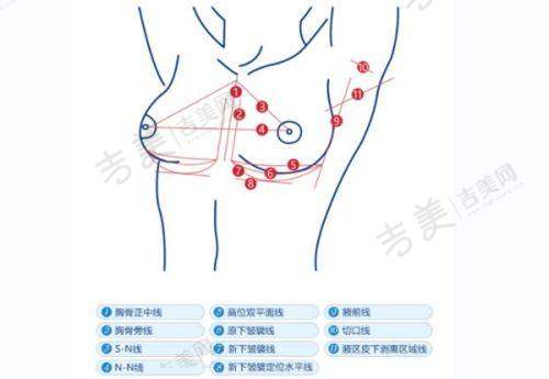 孝感华美医疗美容背部吸脂48000元起，多种吸脂套餐可选，真人案例见证显著效果