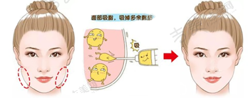 德国法芮娅胸假体的价格与性价比分析