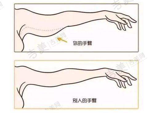 美国Miradry治疗腋臭的过程揭秘
