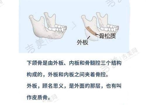 铂蕴假体手感怎么样之实现良好手感的原因