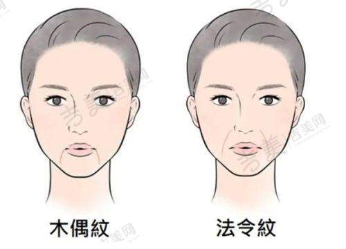 宁夏华美整形美容膨体隆鼻修复52000元起术后护理关键要点