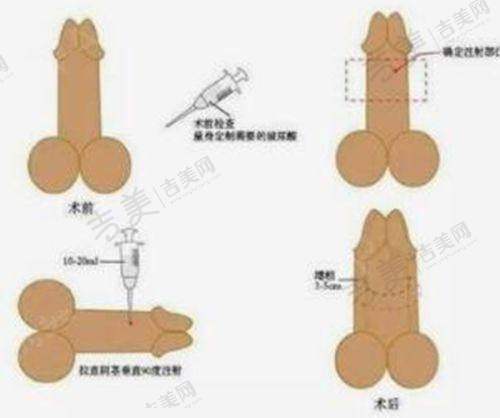 资阳维多利亚医疗美容热拉提18000元起划算吗