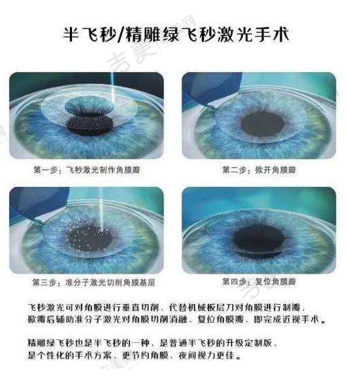 六、重庆何氏眼科和爱尔眼科哪家更好详情之服务质量