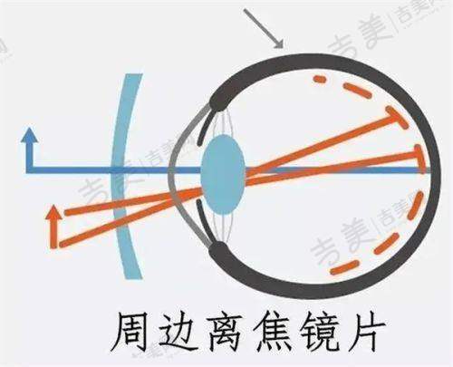 五、西安四院眼科近视手术药费情况详细说明