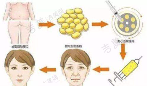 乳房假体挛缩修复方法之日常护理与药物治疗