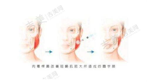 重庆星荣M唇精细化雕刻22800元起，刘正茂微创花瓣唇塑形顾客实例